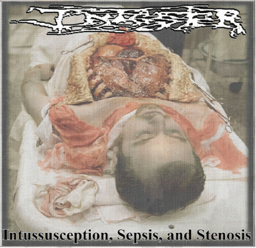 Infester (USA-2) : Intussusception, Sepsis and Stenosis